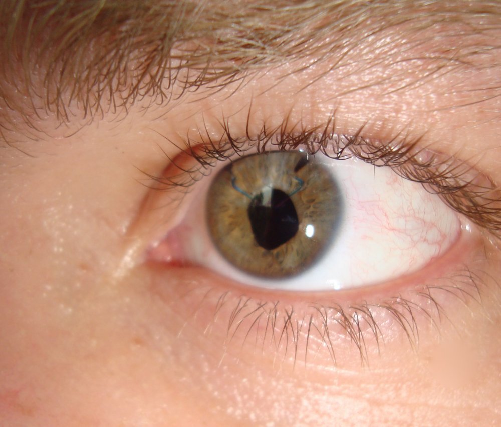 Больная печень симптомы катаракты