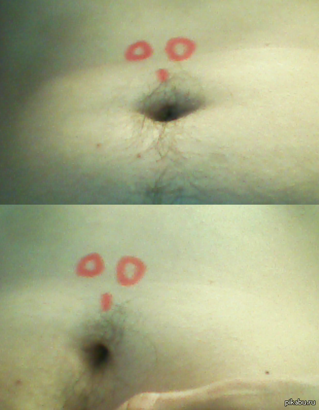 how do you like it? :) - Erysipelas, Navel