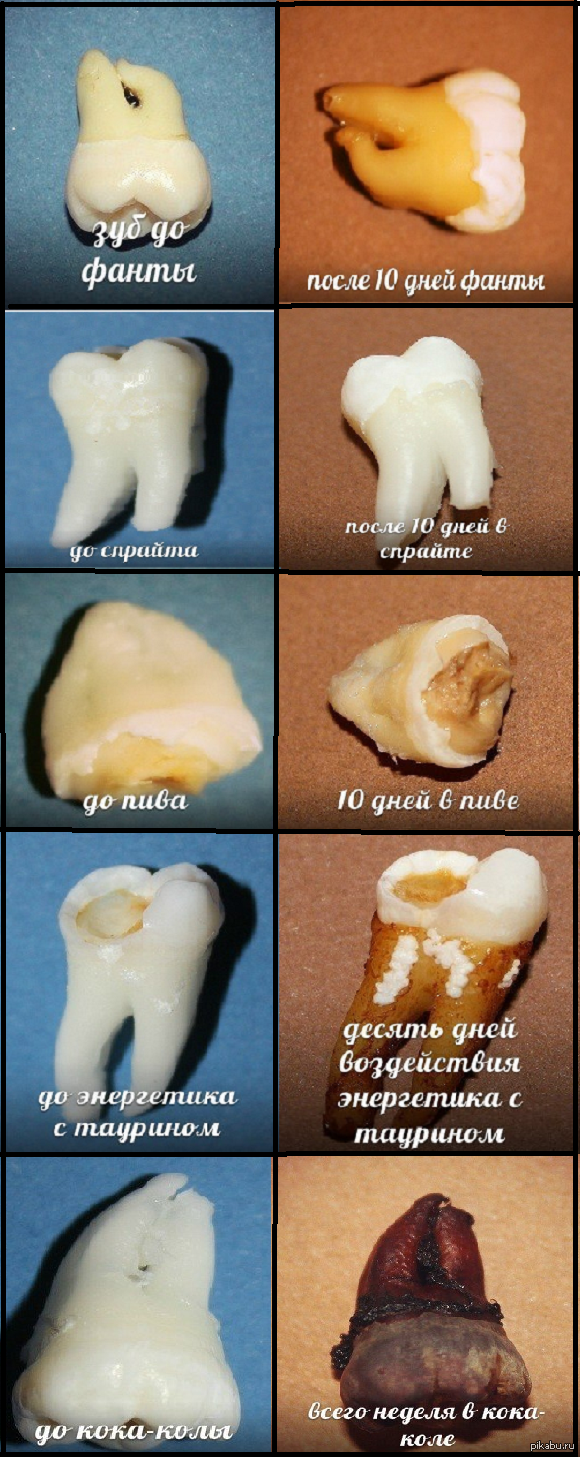 В Америке провели тест, в котором клали удаленные зубы в самые популярные  напитки на 10 дней и вот что получилось. | Пикабу