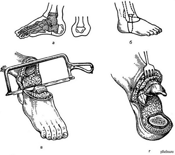 Удаление стоп. Костно-пластическая ампутация стопы по Пирогову. Костно-пластическая ампутация голени по н.и. Пирогову. Костнопластическая ампутация по Пирогову. Костно пластическая ампутация голени по Пирогова.
