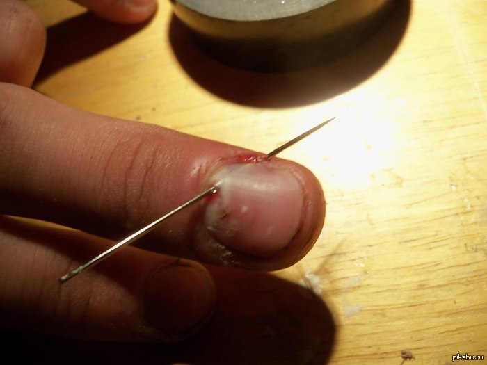 Not for the faint of heart - NSFW, Nails, Needle, Accident