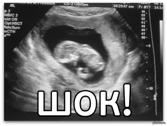 12 недель видео. УЗИ 12 недель беременности. УЗИ малыша на 12 неделе. Снимки УЗИ на 12 неделе.
