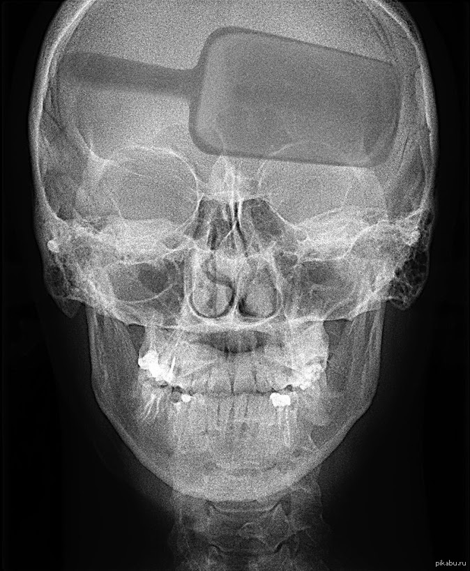 Перелом лицевого черепа