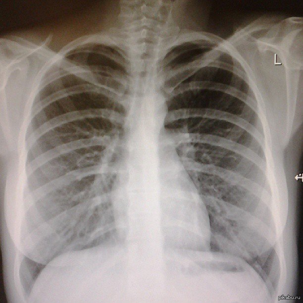 Girlfriend threw a picture of her boobs. - NSFW, Boobs, Girls, X-ray