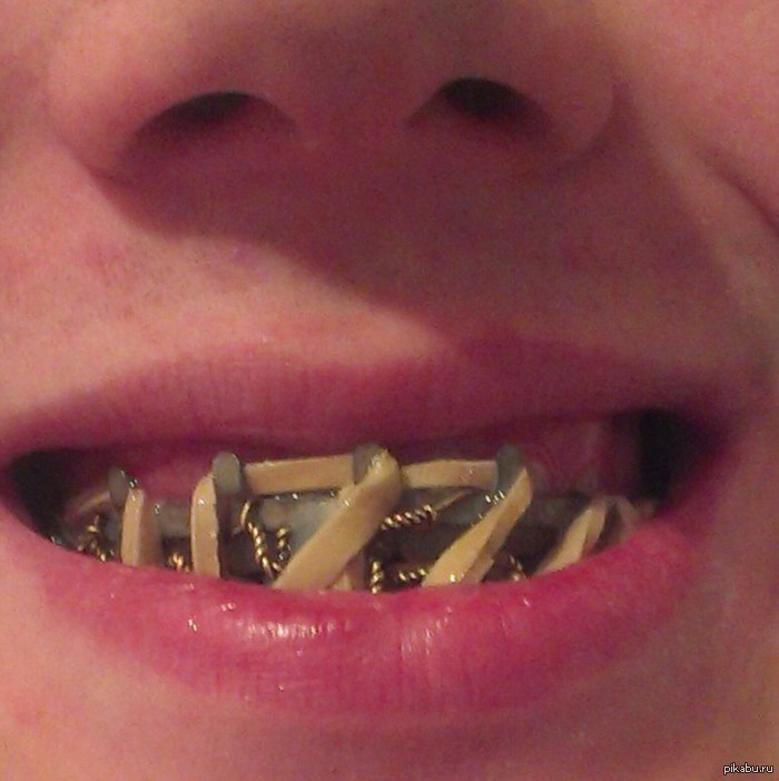 Happy smile day everyone :) (do not watch for the faint of heart :) - NSFW, My, Teeth, Smile Day, Tires