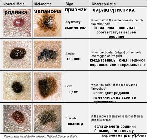Что такое меланома? | Пикабу