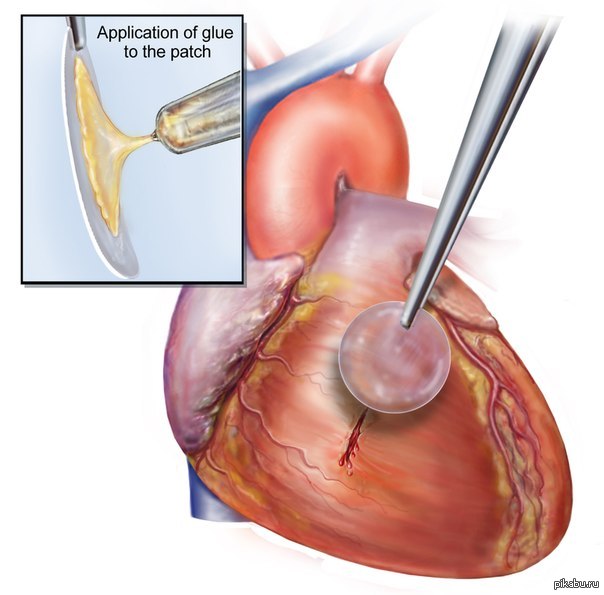 Ученые изобрели суперклей, способный залатать сердечные раны.