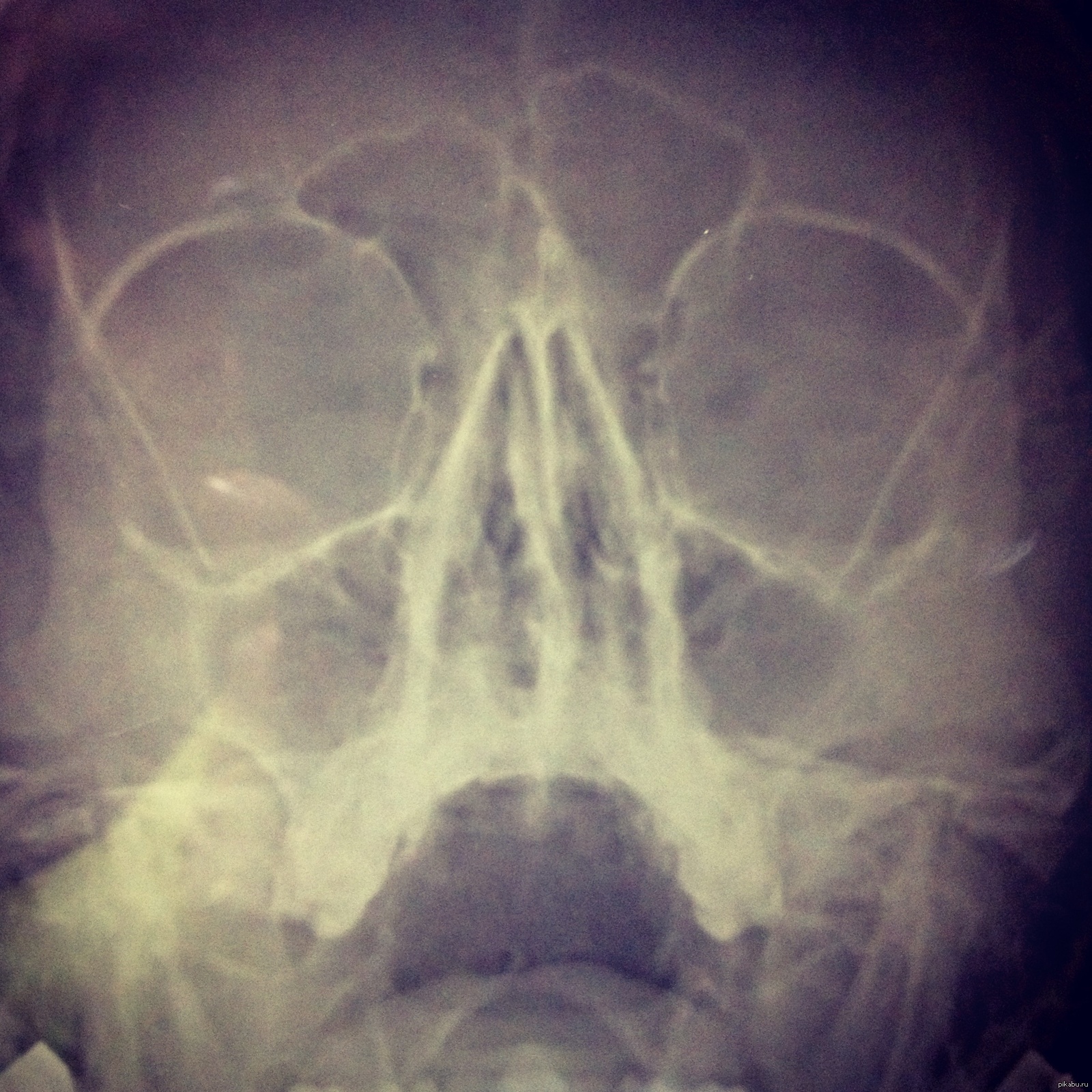 Кривая носовая перегородка рентген