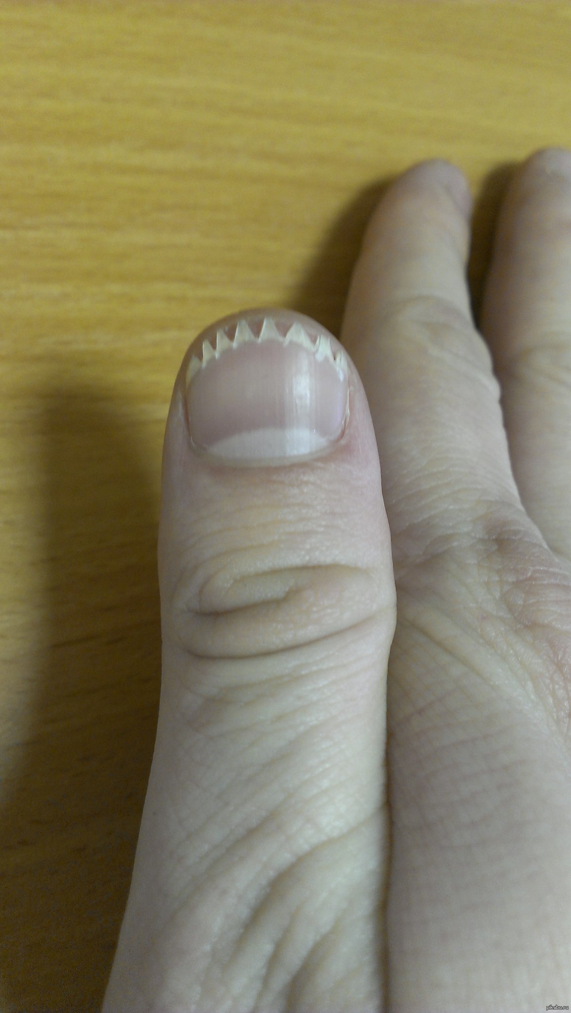 Большой палец без ногтя