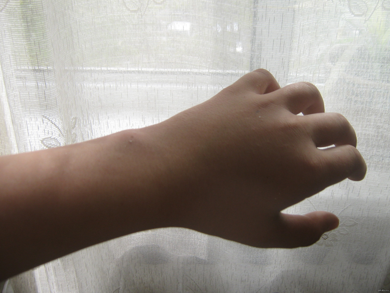 Пальцы после гипса. Переломанная рука безтгипса.